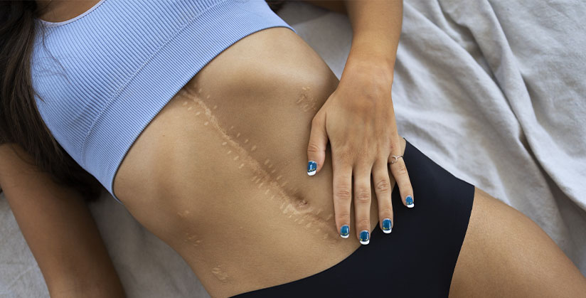 Adhérence cicatrice kiné : comment traiter les cicatrices par la kinésithérapie