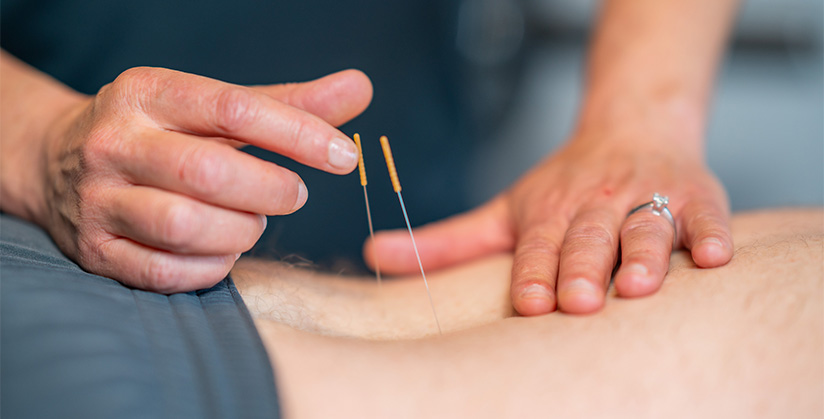 Le Dry Needling : une nouvelle technique de kinésithérapie pour soulager les contractures